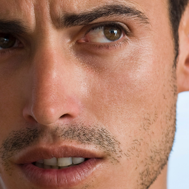 Bigote |Depilación láser Alexandrita Pro de Candela