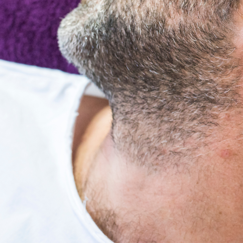 Cuello Anterior Masculino|Depilación láser Alexandrita Pro de Candela