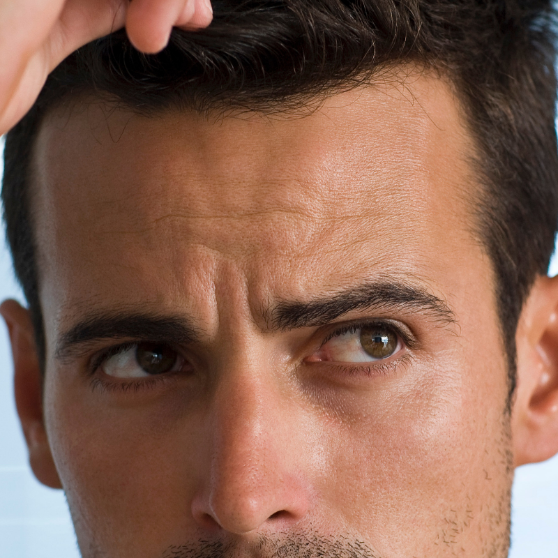 Entrecejas Masculino|Depilación láser Alexandrita Pro de Candela