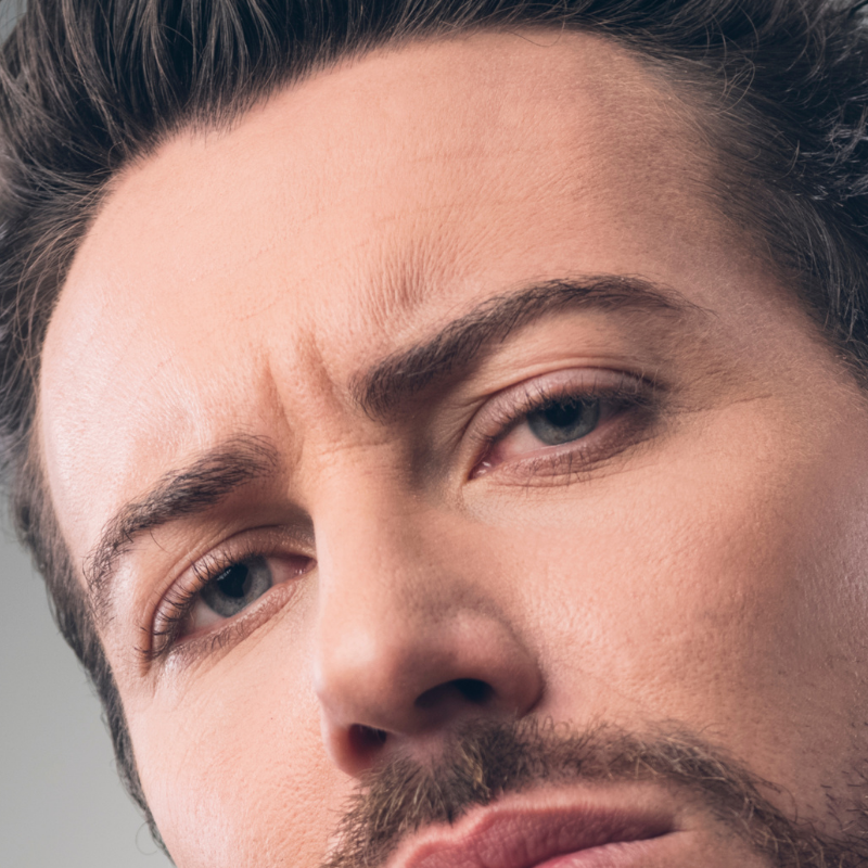 Frente Masculino|Depilación láser Alexandrita Pro de Candela