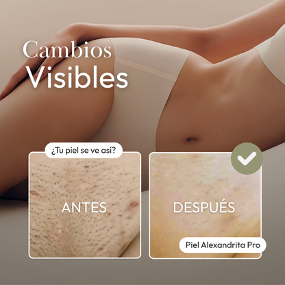 Retoque de Rebaje corto · depilación láser Alexandrita Pro · Kyest San Felipe y Los Andes · imagen 4