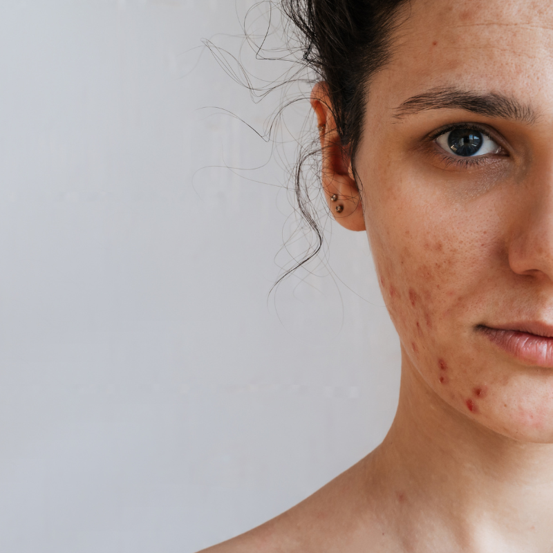 ELIMINACION MANCHAS FACIALES CON LASER  |  Láser Chrome