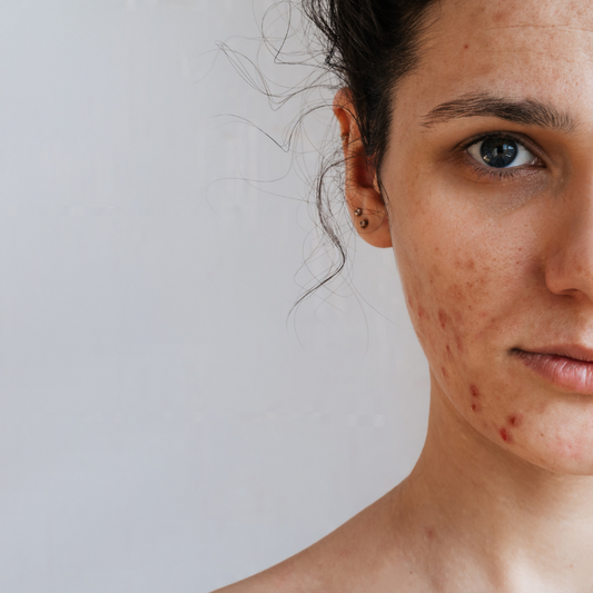 ELIMINACION MANCHAS FACIALES CON LASER  |  Láser Chrome