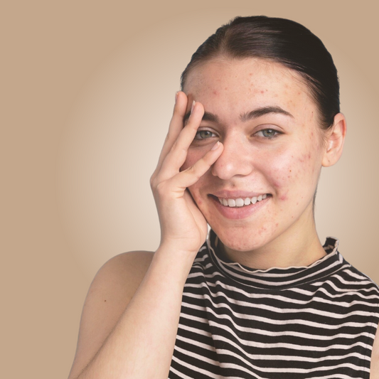 LASER ACNE 1/2 ROSTRO |  Láser Chrome