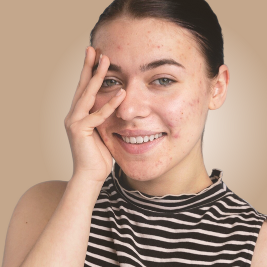 LASER ACNE ROSTRO COMPLETO |  Láser Chrome