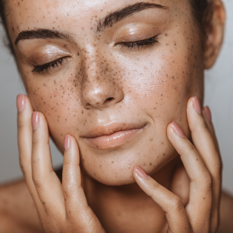 LASER CICATRICES  ROSTRO COMPLETO |  Láser Chrome